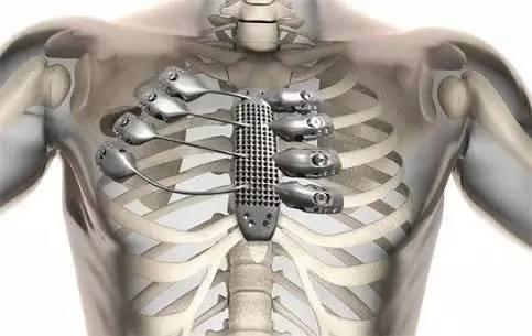 3D打印技术也能用来救治疑难杂症？