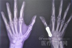 泰国医生完成世界首例3D打印钛金属拇指骨移植